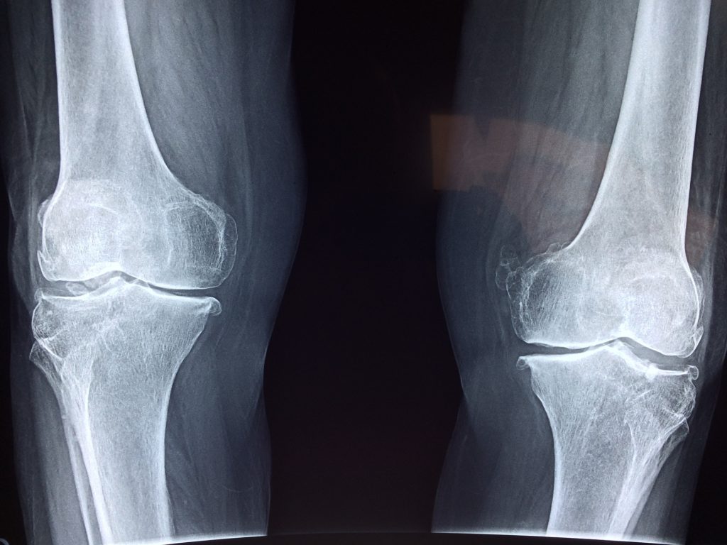 Protein ist nicht schädlich für die Knochen.
Röntgenbildaufnahme.